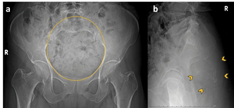 AP pelvis and lateral sacral radiographs of a sacral chordoma with the subtle changes marked