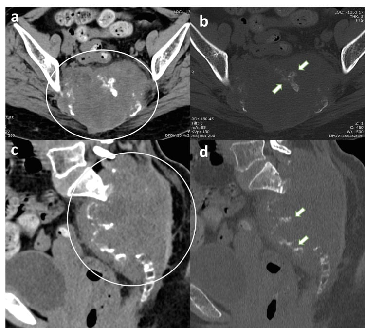 Axial and sagittal CT showing sacral destruction and internal calcification