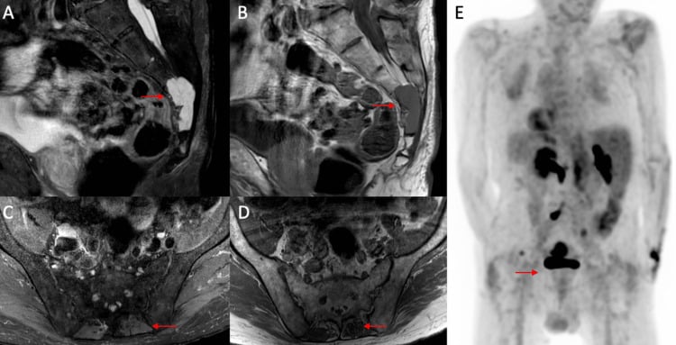 Sacral chordoma on sagittal and axial MRI with whole-body FDG-PET