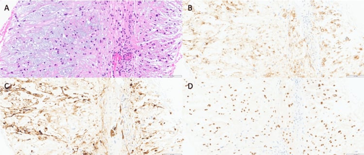 Core-biopsy H&E and S-100 EMA and brachyury staining in chordoma