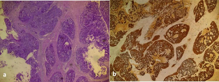 Lobulated conventional chordoma with diffuse brachyury immunoreactivity