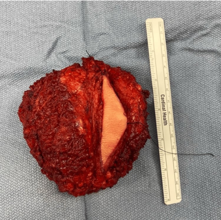 En bloc sacrectomy specimen containing chordoma and surrounding tissue, beside a ruler