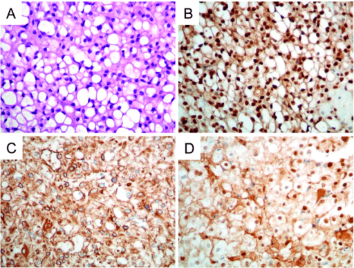 Chordoma histopathology showing physaliferous cells and immunohistochemistry