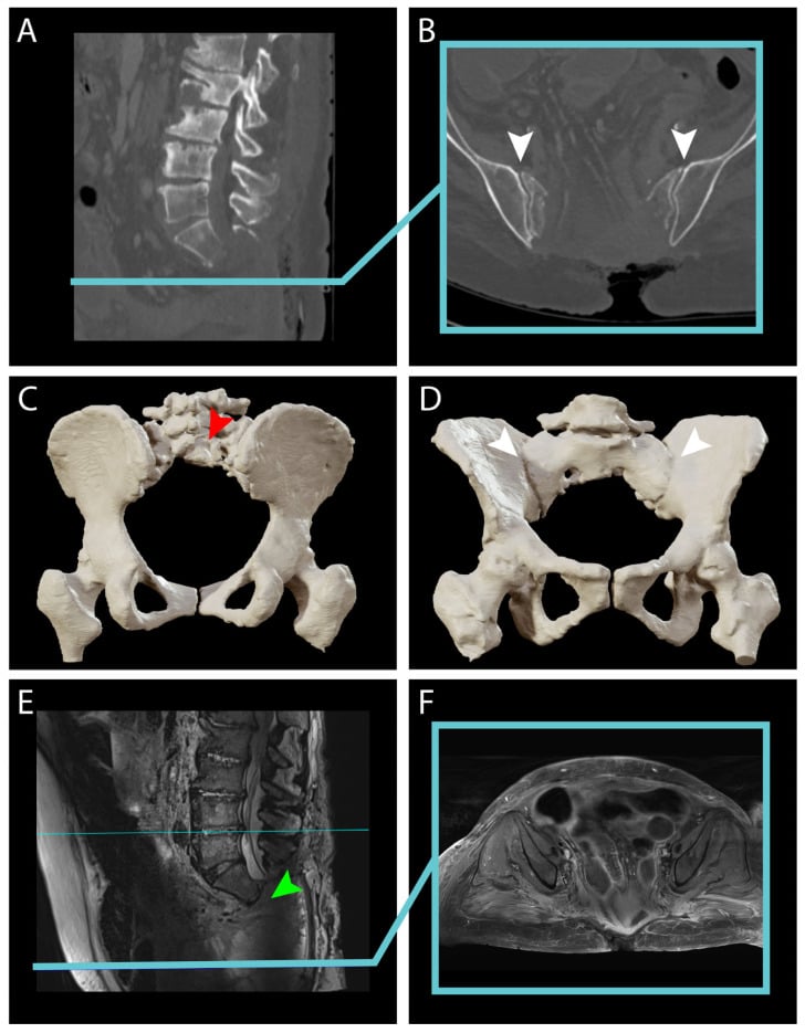 Postoperative CT, three-dimensional reconstruction and MRI after sacrectomy