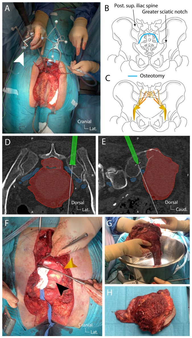 Navigation-guided sacral osteotomy and en-bloc tumour removal