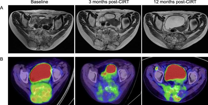 Serial MRI and FDG-PET after carbon-ion radiotherapy for sacral chordoma