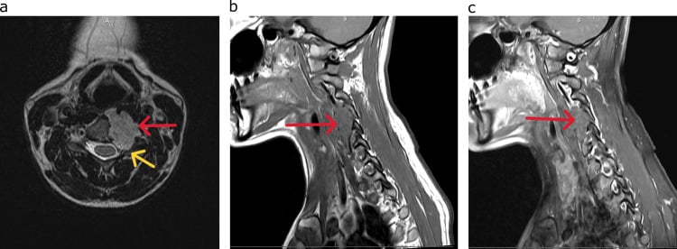 Axial and sagittal MRI of a cervical vertebral-body chordoma