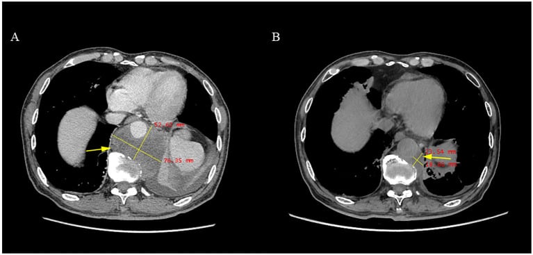 Axial CT before and after anlotinib for advanced chordoma