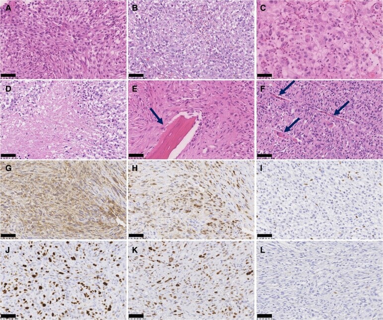 Histology and immunophenotype of paediatric poorly differentiated chordoma