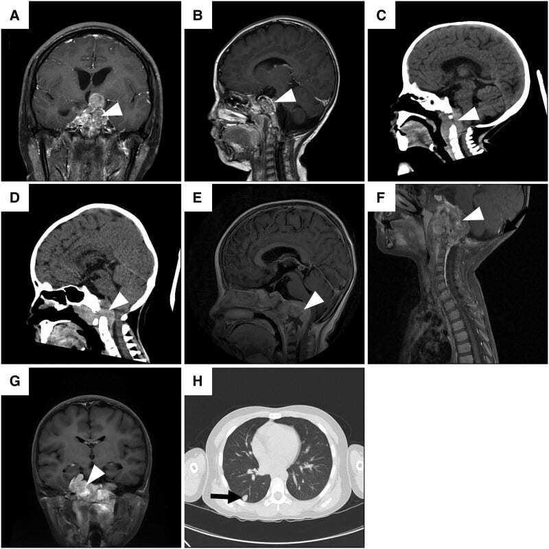 Paediatric poorly differentiated chordomas on skull-base imaging with a pulmonary metastasis