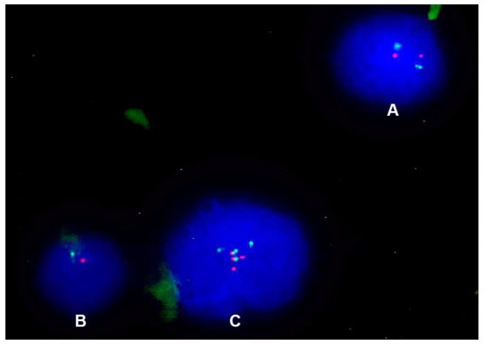 FISH patterns showing normal SMARCB1 signals monoallelic deletion and copy-number gain