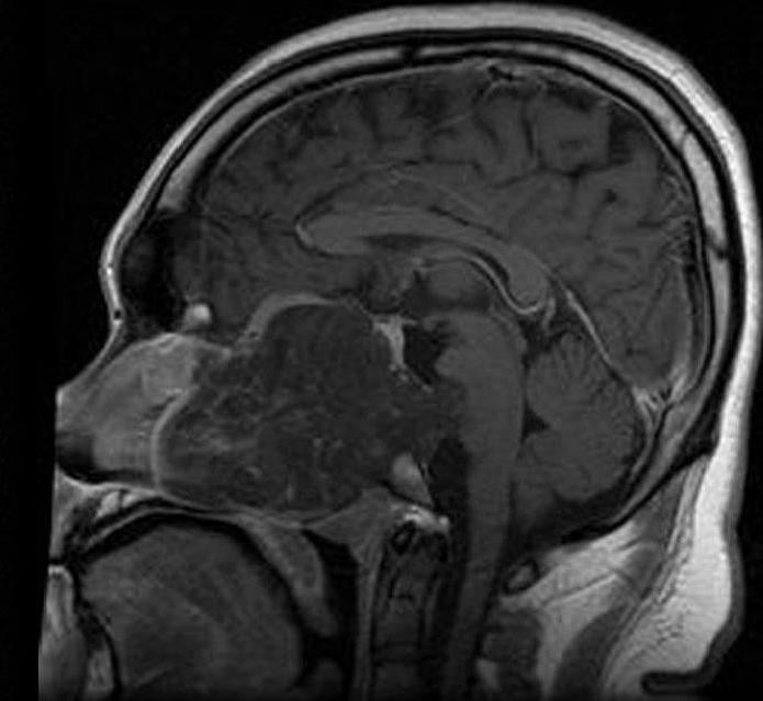 Sagittal T1-weighted MRI of an extensive clival chordoma extending from the nasopharynx to the brainstem in a 17-year-old male.