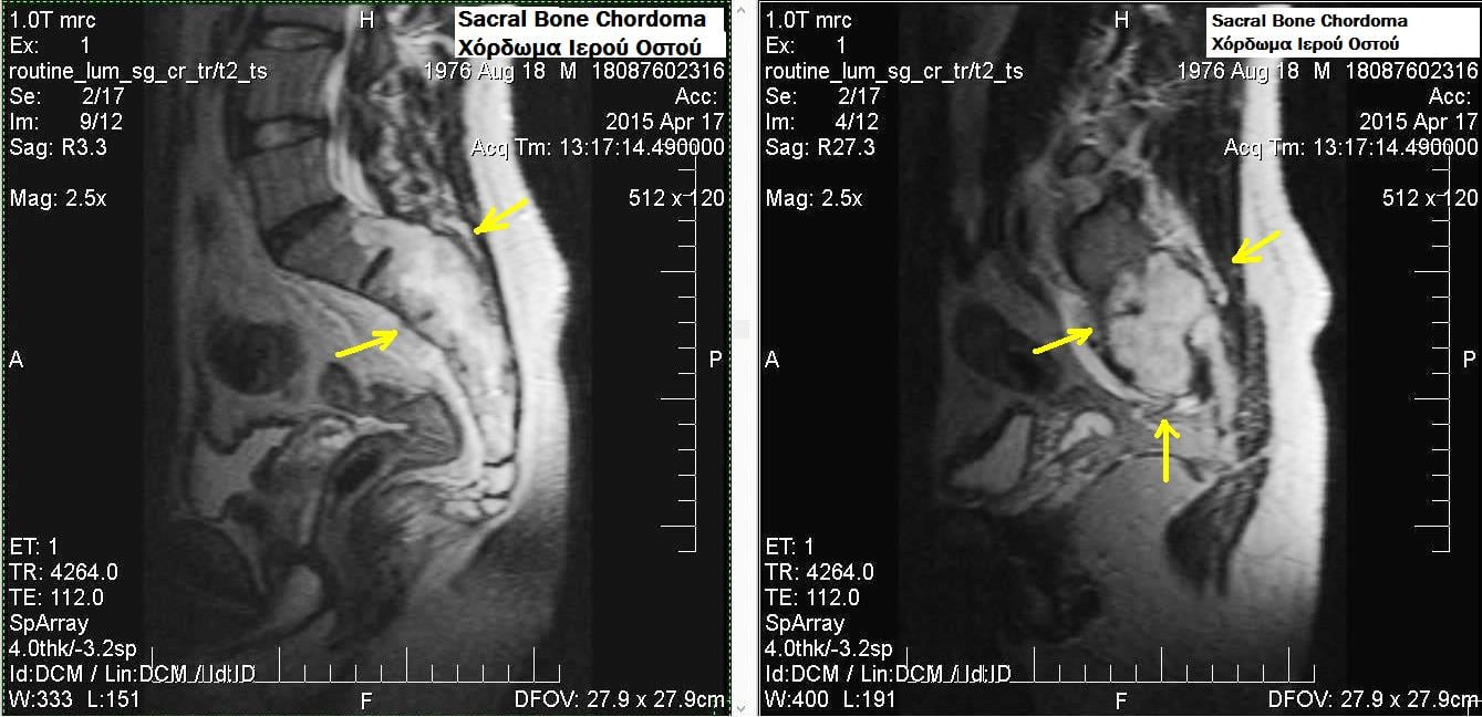 Sagittal MRI of a sacral chordoma showing a destructive sacral lesion with a presacral soft-tissue component.