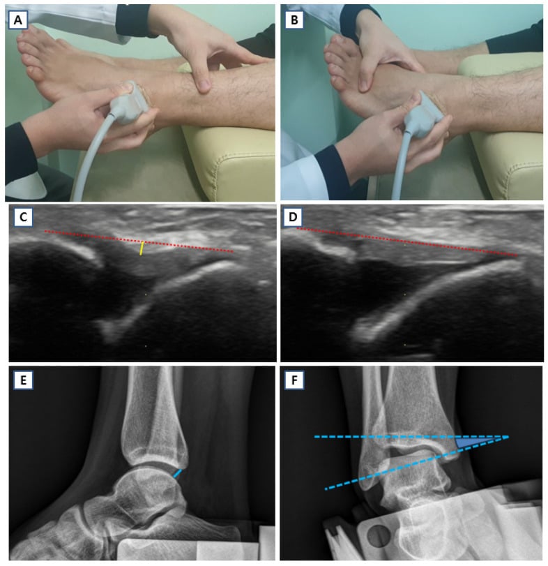 Stress ultrasound and stress radiography for quantifying ankle laxity