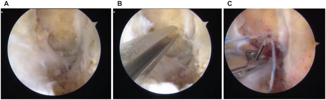 Arthroscopic ATFL footprint preparation suture passage and tensioning