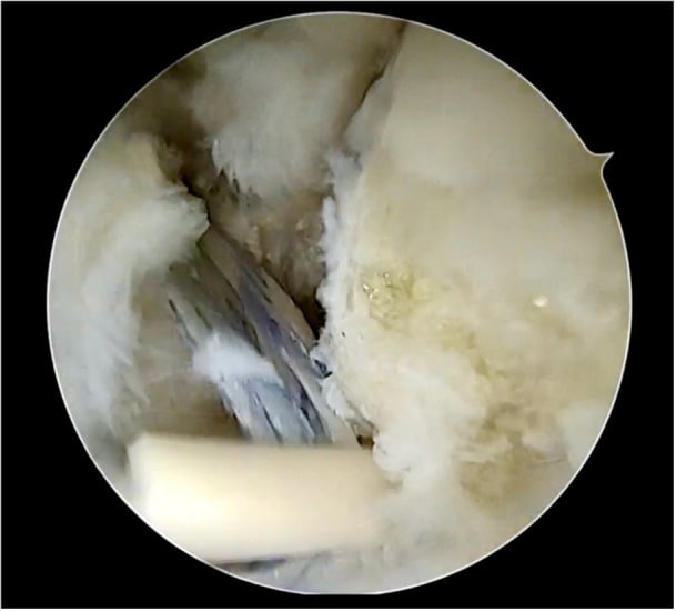 Completed arthroscopic internal-brace construct across the ATFL