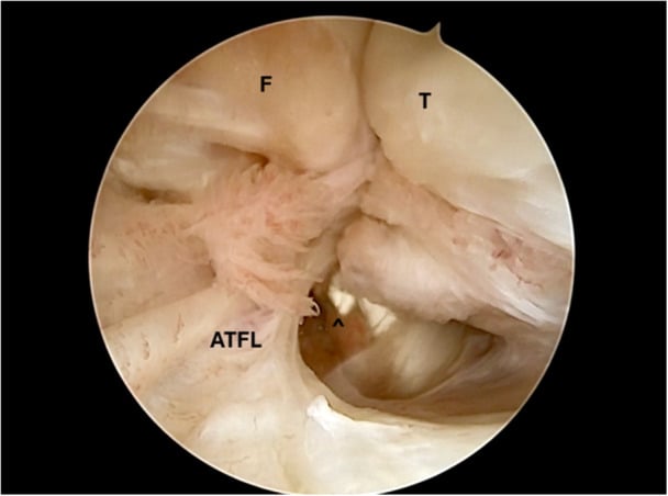 Arthroscopic view of an ATFL tear between fibula and talus, labelled F, T and ATFL