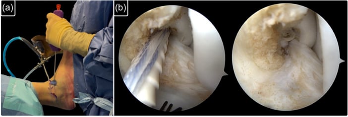 All-inside knotless anchor fixation of the ATFL to its fibular footprint