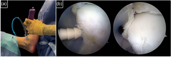 Talar anchor placement for suture-tape augmentation of arthroscopic ATFL repair