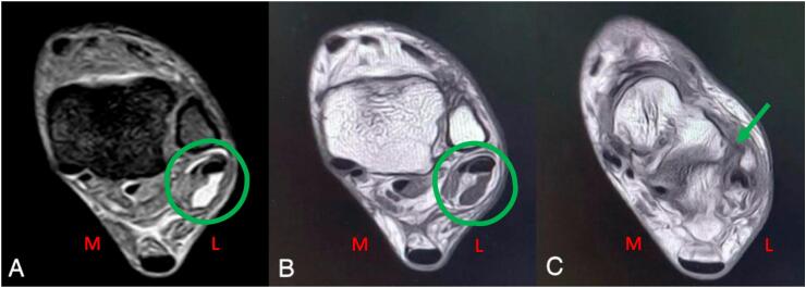 MRI showing peroneal tendinopathy subluxation and associated ATFL tear