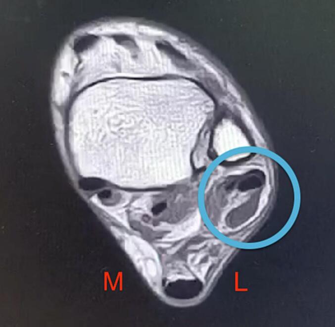 MRI after combined peroneal and lateral-ligament stabilisation, the retromalleolar peroneal complex circled