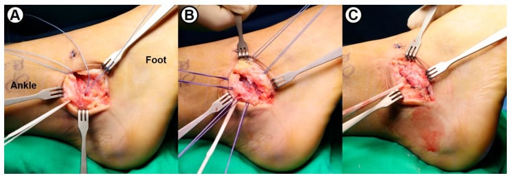 Open modified Broström repair with capsuloligamentous imbrication