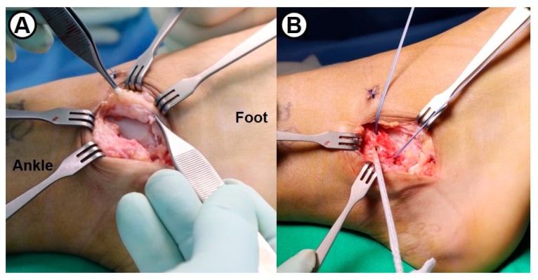 Poor-quality lateral ligament tissue reconstructed with anchors and suture tape