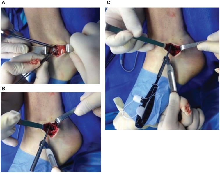 Open ATFL footprint preparation suture drilling and ligament tensioning