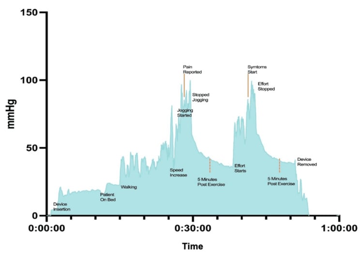 Continuous intracompartmental pressure trace during treadmill provocation
