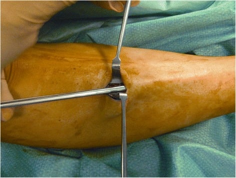 Distal division of anterior and lateral compartment fascia during CECS fasciotomy