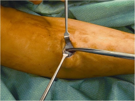 Proximal division of anterior and lateral compartment fascia during CECS fasciotomy