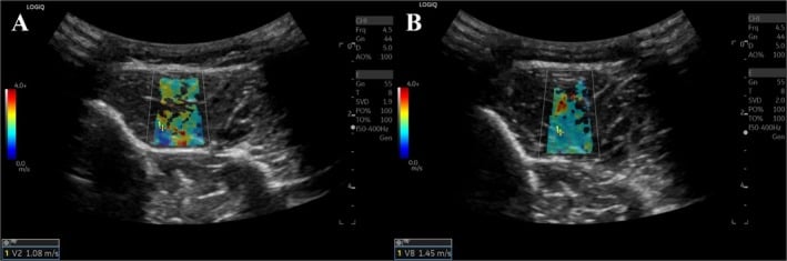 Paired pre- and post-exercise shear-wave elastography images in anterior-compartment CECS