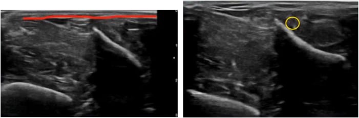 Ultrasound localisation of the superficial fibular nerve before percutaneous fasciotomy