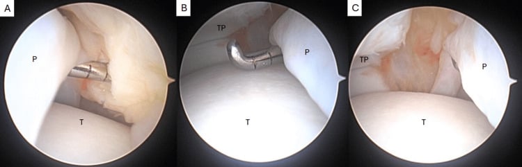 Arthroscopic views confirming an ankle plica crossing the talus