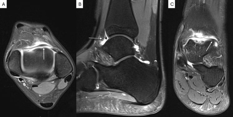 Multiplanar ankle MRI showing an intra-articular plica