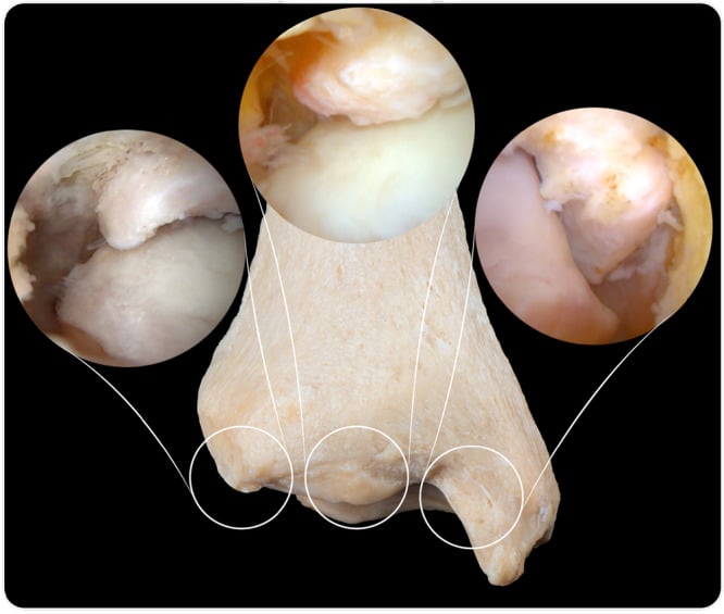 Arthroscopic map of lateral central and medial anterior ankle osteophytes