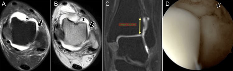 MRI MR arthrography and arthroscopy showing full-thickness ATFL tear