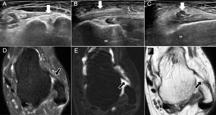 Ultrasound and MRI showing full-thickness ATFL tear with intact peroneal tendons