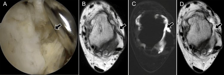 Arthroscopy MRI and MR arthrography showing chronic ATFL deficiency