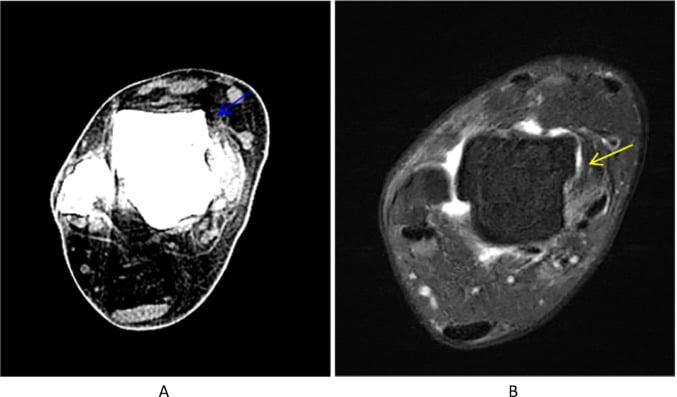 Axial T2 MRI and WBCT demonstrating complete chronic ATFL rupture