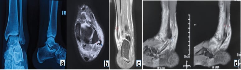 Axial T2 MRI demonstrating C-shaped split tear of peroneus brevis tendon