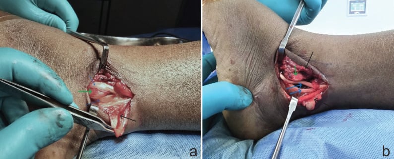 Intraoperative photograph demonstrating longitudinal split tear of peroneus brevis tendon