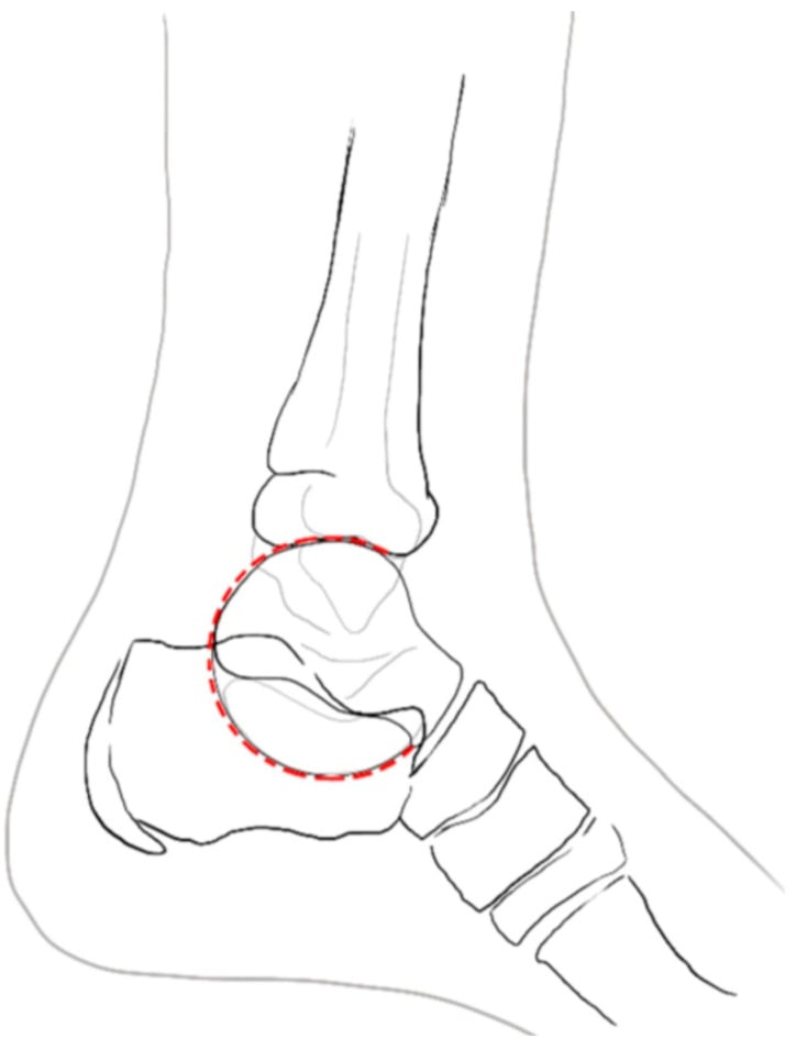 Lateral ankle schematic showing the C-sign of talocalcaneal coalition