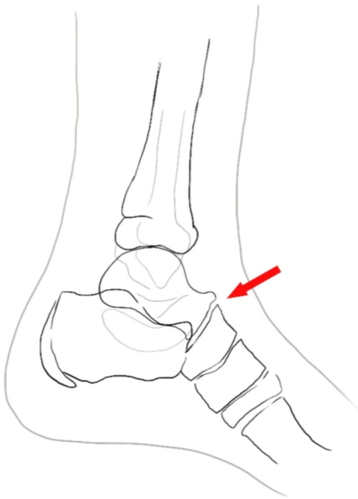Lateral ankle schematic showing talar beak in tarsal coalition