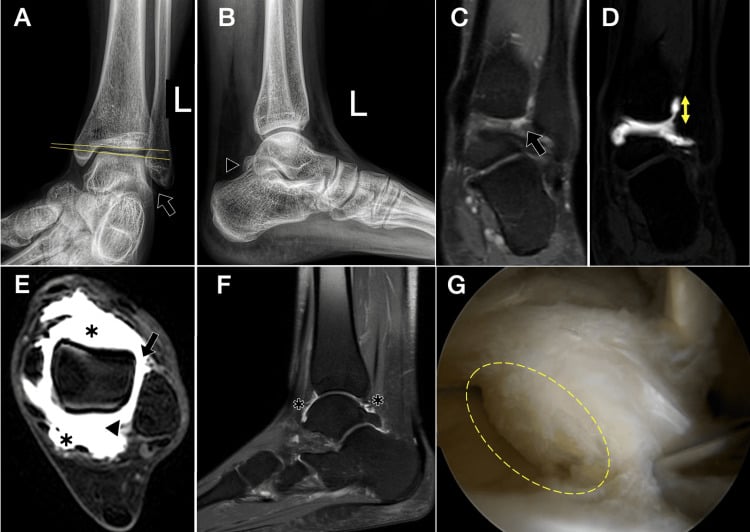 Radiographs MRI ultrasound and arthroscopy assessing chronic ankle instability