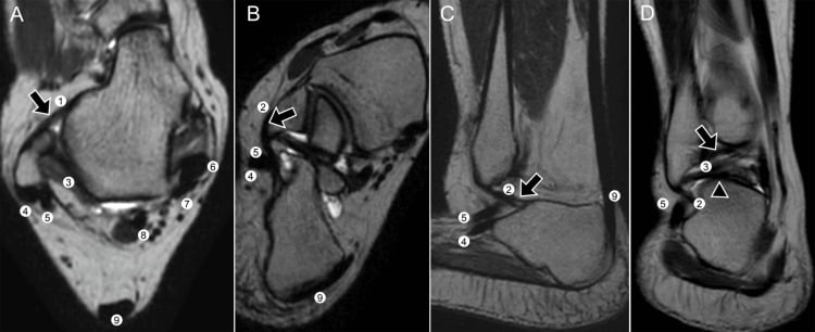 Multiplanar ankle MRI showing the lateral ligament complex and surrounding tendons