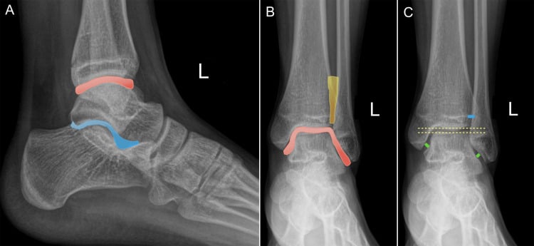 Normal weight-bearing ankle radiographs showing tibiotalar subtalar and syndesmotic alignment