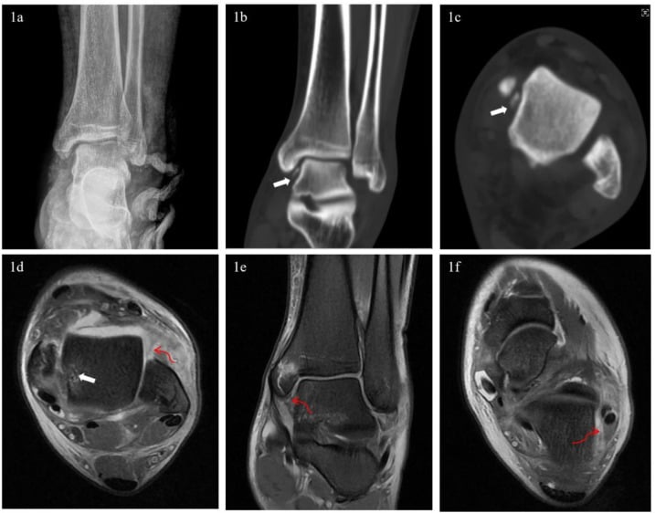 Radiograph CT and MRI showing talar osteochondral fracture and marrow oedema