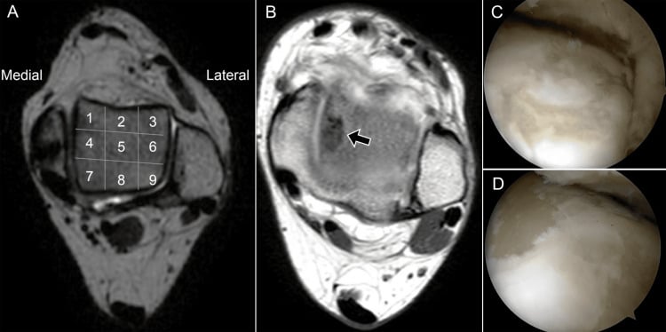 MRI and arthroscopy localising a medial talar osteochondral lesion