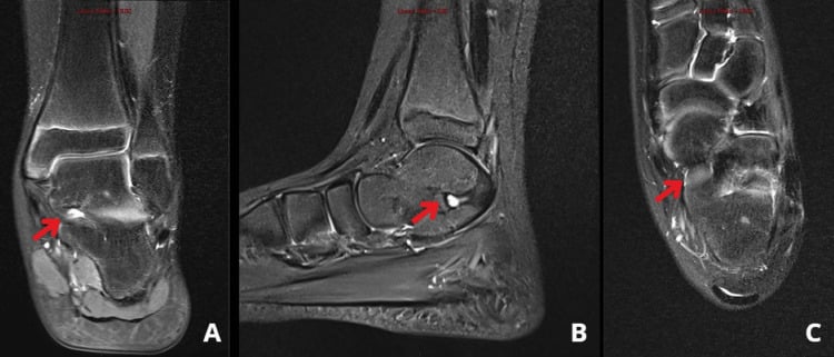 Coronal sagittal and axial MRI showing fibrous talocalcaneal coalition